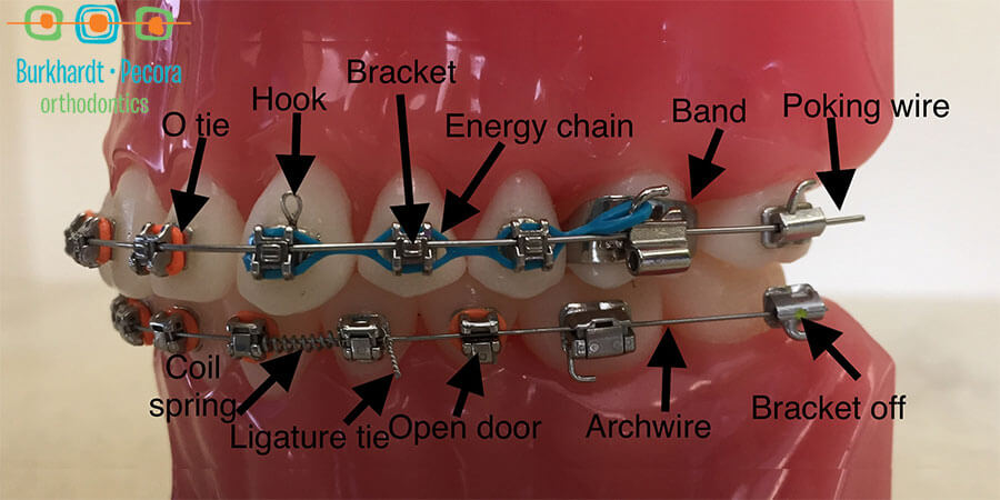 Orthodontic Emergencies, Burkhardt Pecora Orthodontics